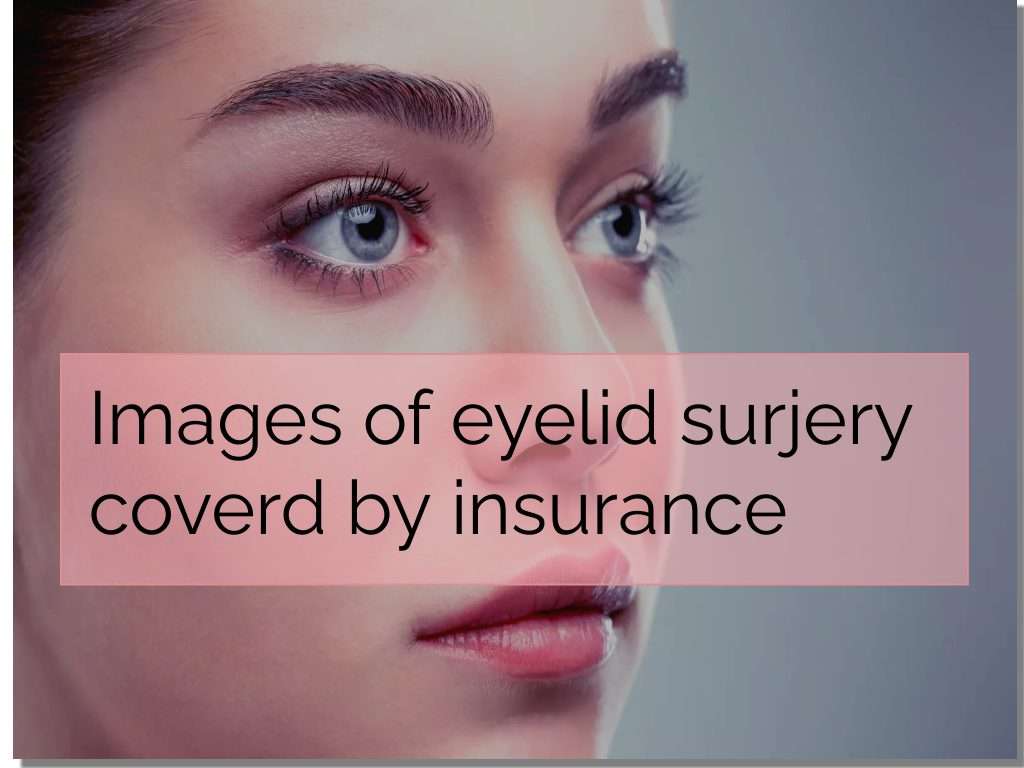 Images of eyelid surgery covered by insurance