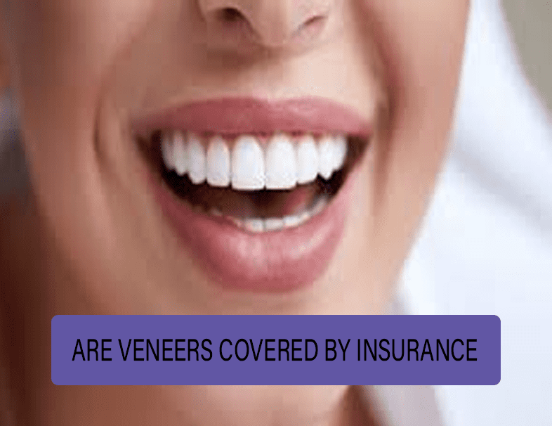 Are Veneers Covered by Insurance