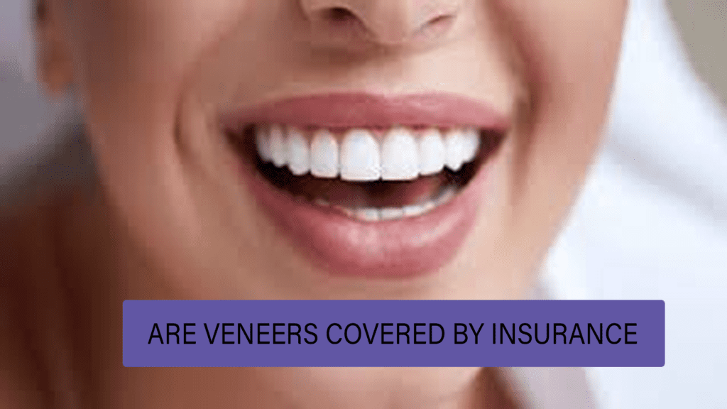 Are Veneers Covered by Insurance