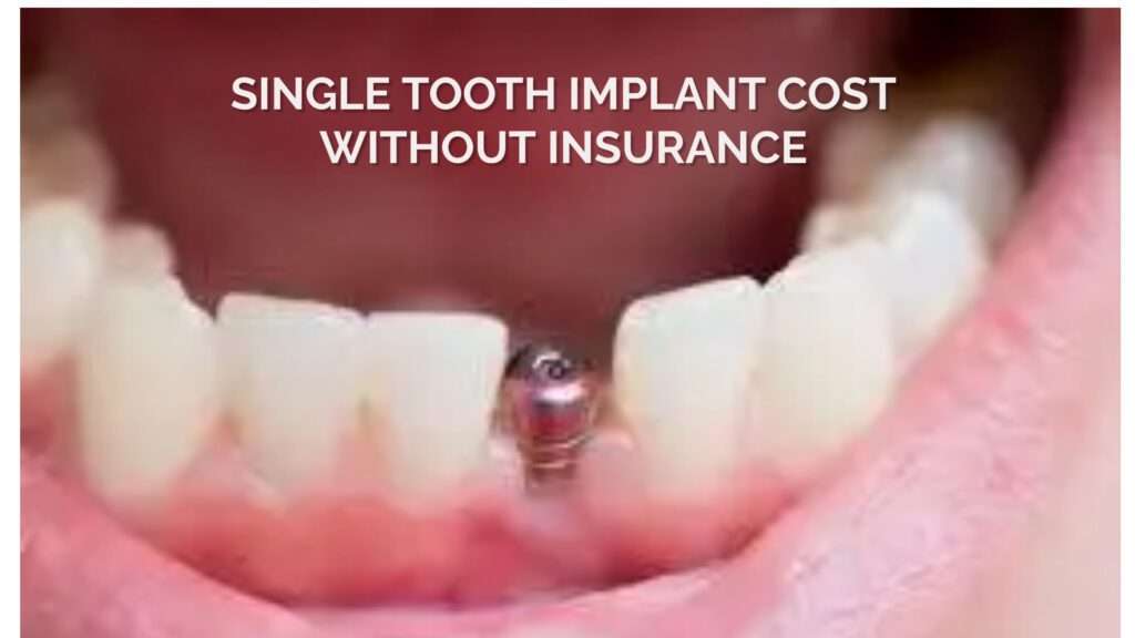 SINGLE TOOTH IMPLANT COST WITHOUT INSURANCE