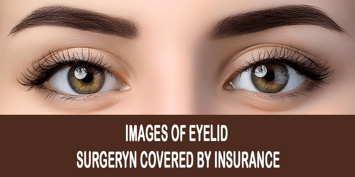 images of eyelid surgery covered by insurance